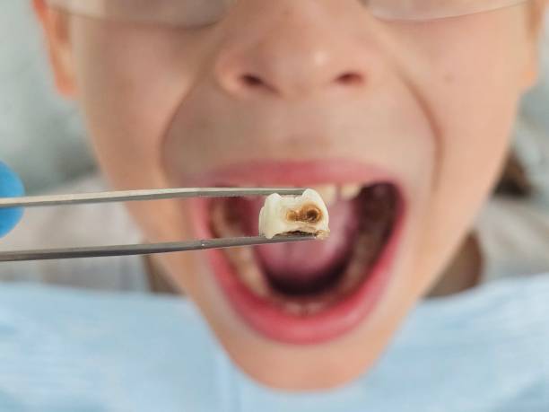 Best Emergency Wisdom Teeth Removal in Clarksville, IA