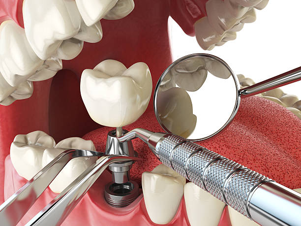 Best Emergency Broken Tooth Repair in Clarksville, IA